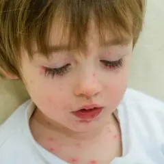 Ile trwa ospa wietrzna u dziecka? Zaskakujące fakty o chorobie