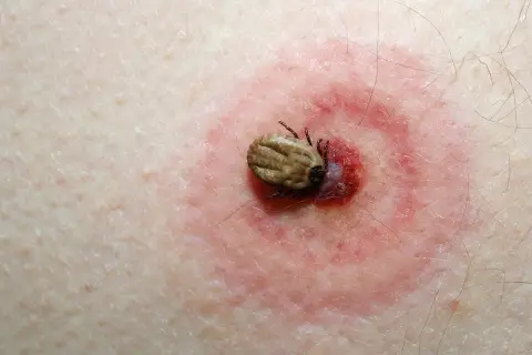 Kleszcz u dziecka: kiedy antybiotyk jest naprawdę potrzebny?