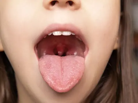 Angina ropna u dziecka ile trwa i jak skutecznie leczyć objawy