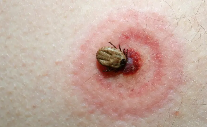 Kleszcz u dziecka: kiedy antybiotyk jest naprawdę potrzebny?
